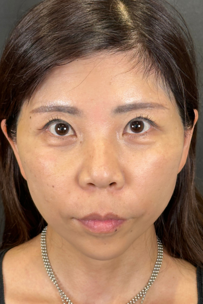 手术前的状态 其一