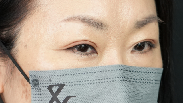 手術前の状態 その1