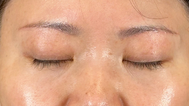 手术前的状态 其一