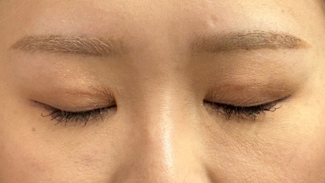 手术前的状态 其一