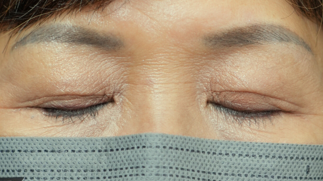 手术前的状态 其一