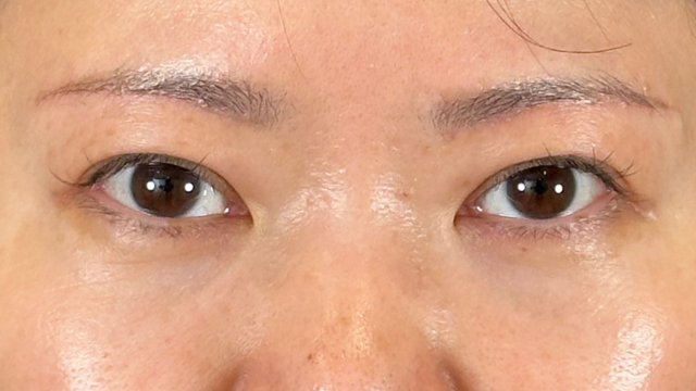 手术前的状态 其一