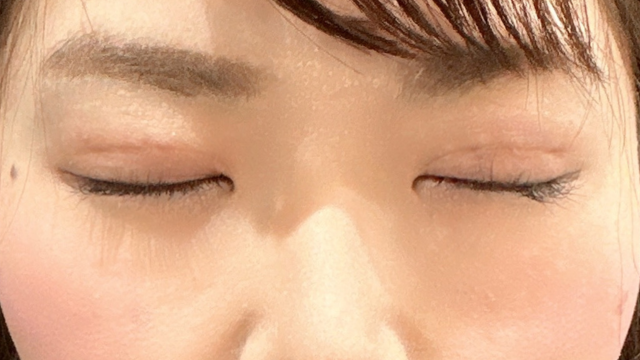 手术前的状态 其一