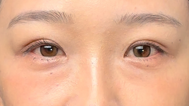 手术前的状态 其一