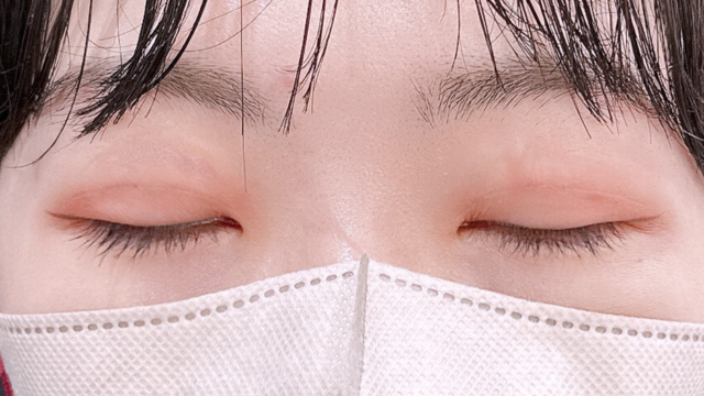 手術前の状態 その1