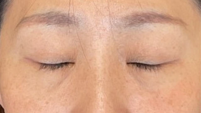 手术前的状态 其一