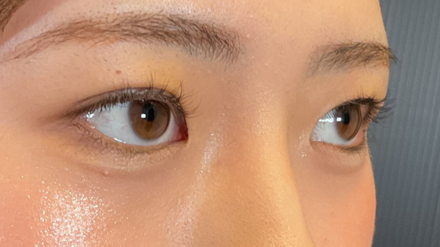 手術前の状態 その1