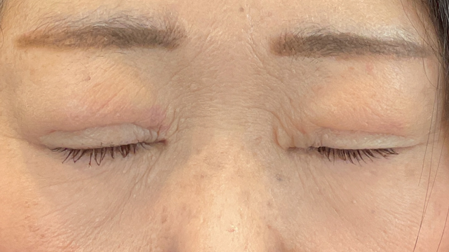 手术前的状态 其一