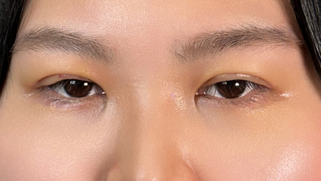 手术前的状态 其一