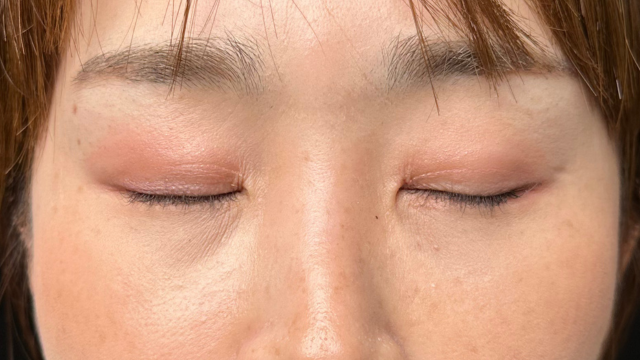 手术前的状态 其一