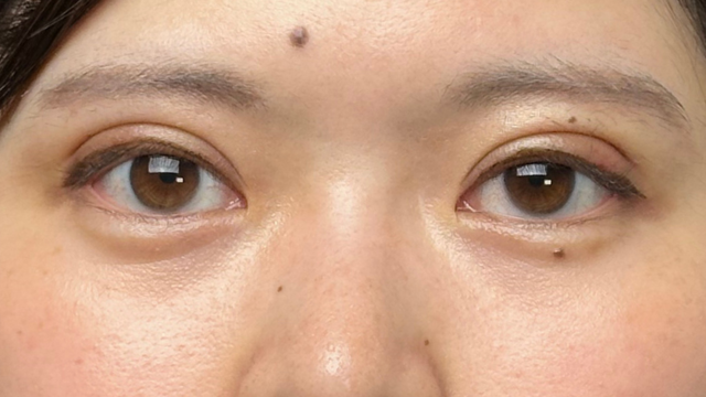 手术前的状态 其一