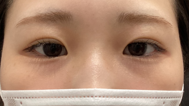 手术前的状态 其一