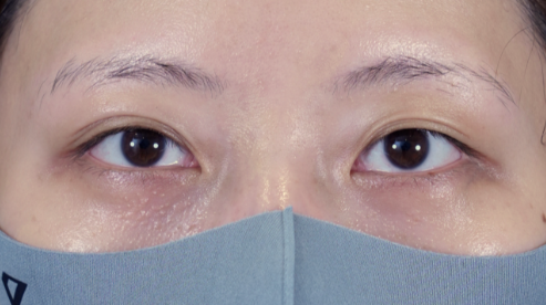 手术前的状态 其一