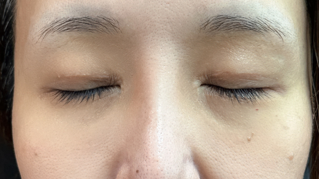 手術前の状態 その1