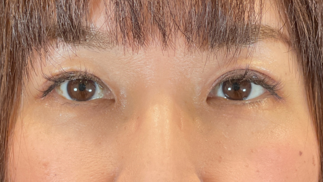 手术前的状态 其一