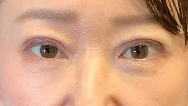 手術前の状態 その1