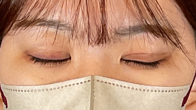 手术前的状态 其一