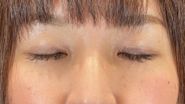 手术前的状态 其一