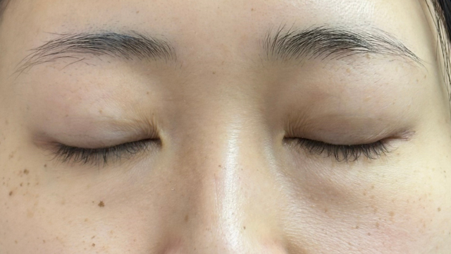 手术前的状态 其一