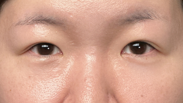 手术前的状态 其一