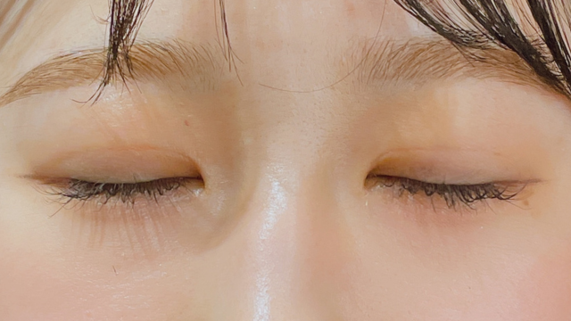 手术前的状态 其一