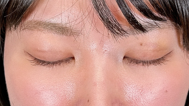 手術前の状態 その1