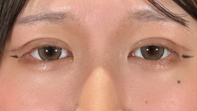 手术前的状态 其一