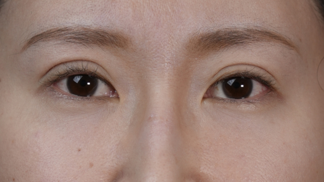 手術前の状態 その1