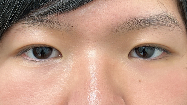 手術前の状態 その1