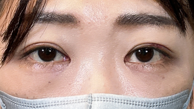 手術前の状態 その1