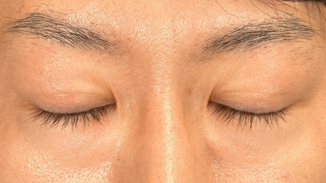 手术前的状态 其一