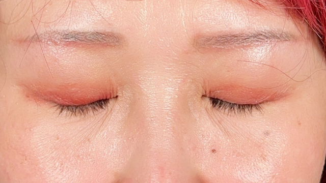 手术前的状态 其一