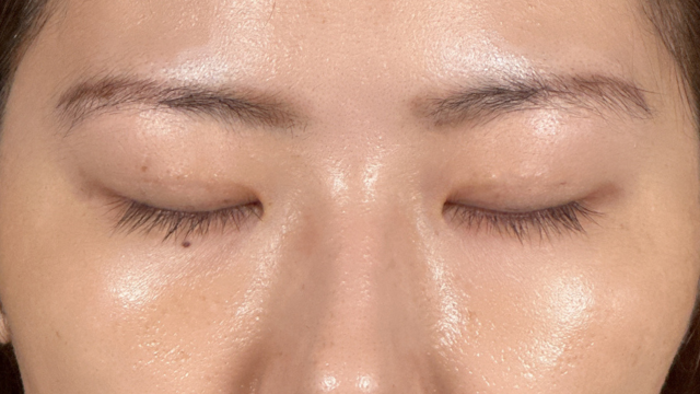 手术前的状态 其一