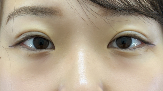 手术前的状态 其一