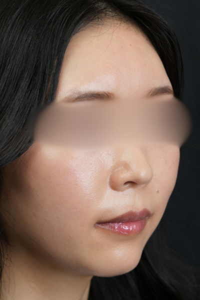 手術前の状態 その1