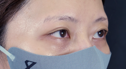 手术前的状态 其一