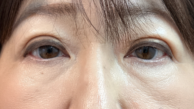 手术前的状态 其一