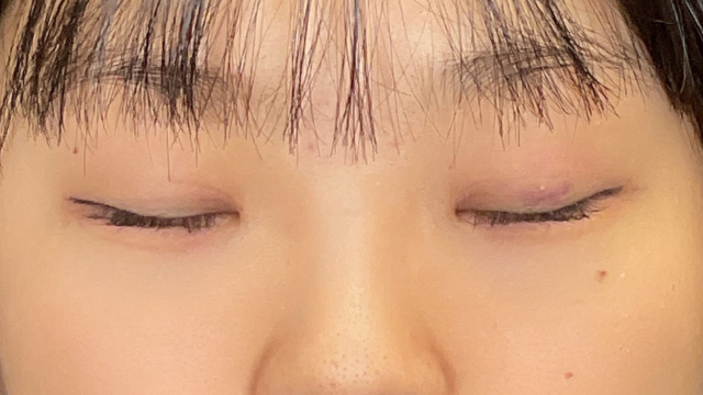 手術前の状態 その1