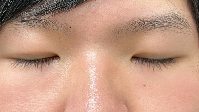 手術前の状態 その1