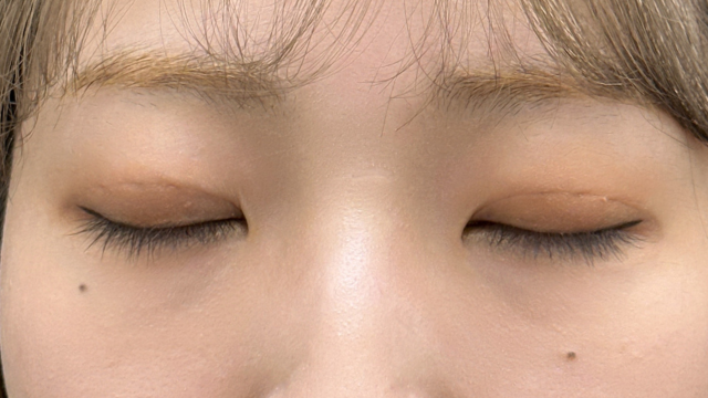 手术前的状态 其一