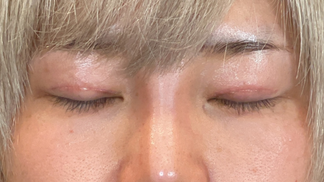 手術前の状態 その1