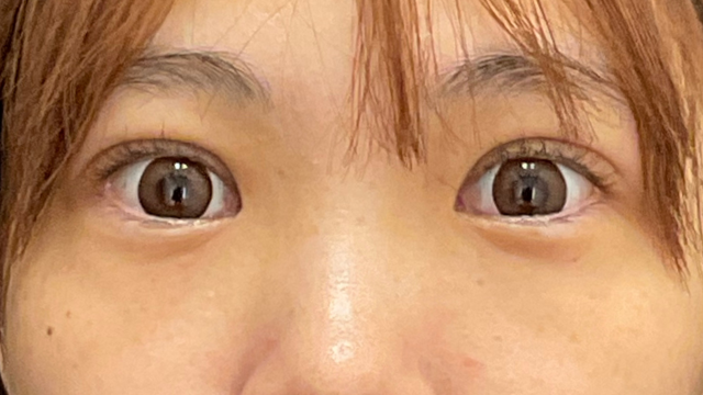 手术前的状态 其一