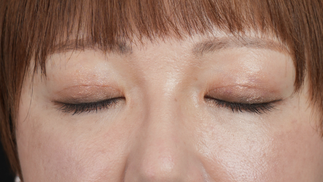 手术前的状态 其一