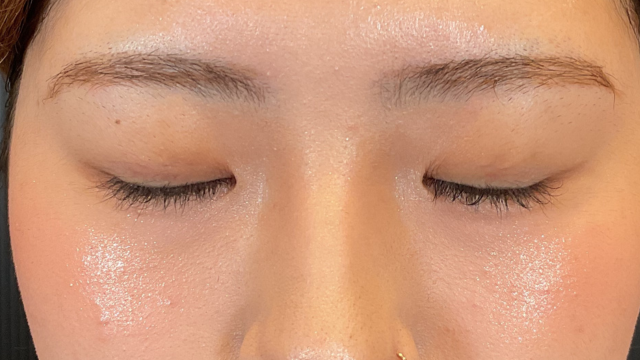 手術前の状態 その1