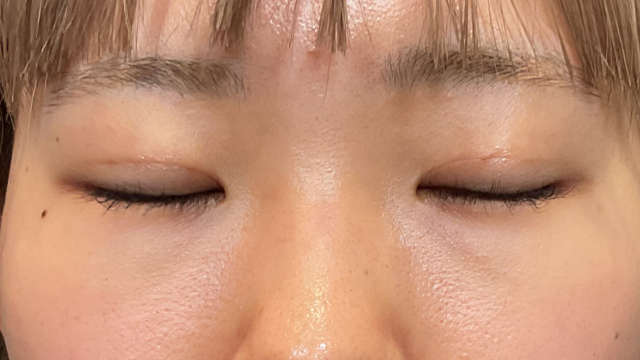 Postoperative Condition Part 1