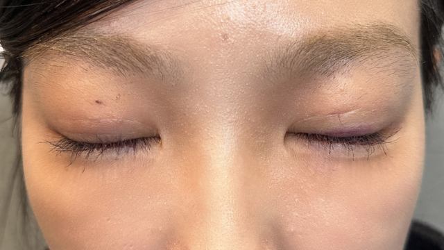 手术前的状态 其一