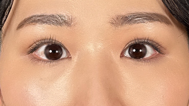 手術前の状態 その1