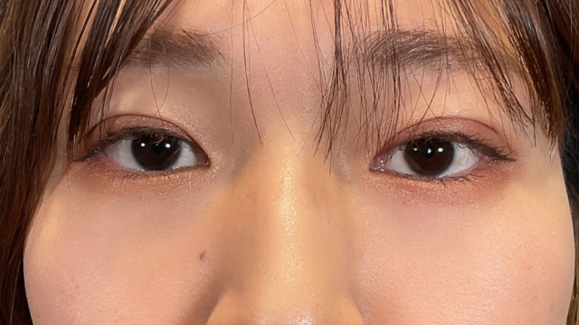 手術前の状態 その1