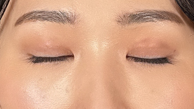 手術前の状態 その1