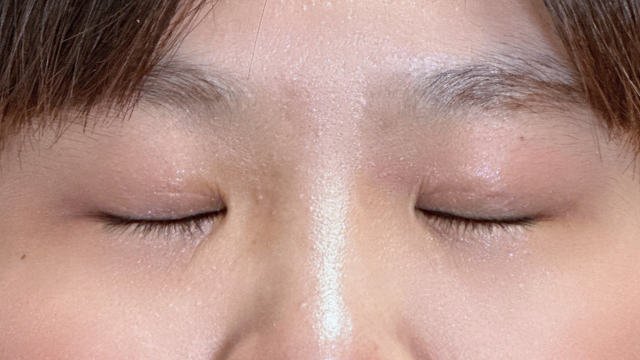 手术前的状态 其一